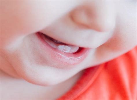 bebeklerde diş etinde şişlik
